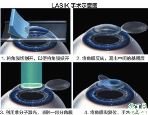 激光近视矫正手术伤眼睛吗 眼睛近视激光会不会有后遗症3